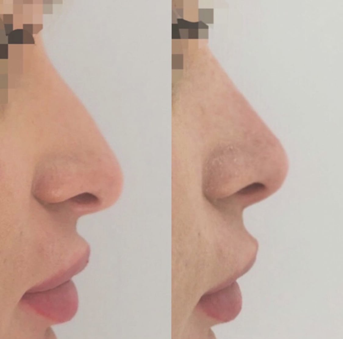 Rhinoplastie médicale femme Bordeaux