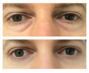 IMG_4976 photo avant après chirurgie des paupières de l'homme